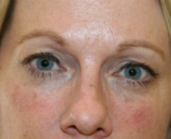 Filler beneath lower eyelids - after - front