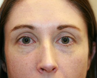 Filler for darkness of lower eyelids - before - front