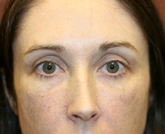 Filler for darkness of lower eyelids - after - front