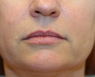 Restylane Defyne Lip Enlargement - before - front