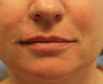 Restylane Defyne Lip Enlargement - after - front