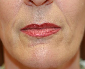 Lip Creases Lip Lines and Slight Lip Augmentation - before - front