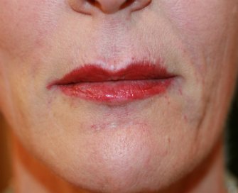 Lip Creases Lip Lines and Slight Lip Augmentation - after - front