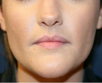 Belotero Lip Augmentation - before - front