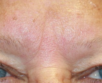 Gel Filler (Restylane Fine Line) into brow creases - before - front