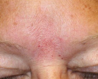 Gel Filler (Restylane Fine Line) into brow creases - after - front