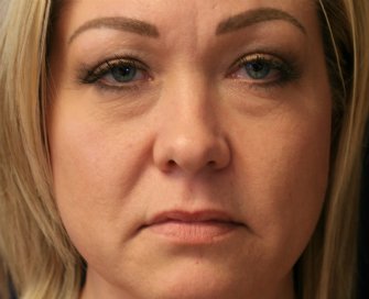 Filler Lower Eyelids and Corners of Lips - before - front