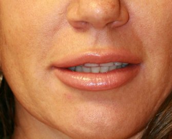 Juvederm Ultra Plus 1 ml lip augmentation - before - front