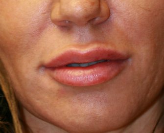 Juvederm Ultra Plus 1 ml lip augmentation - after - front