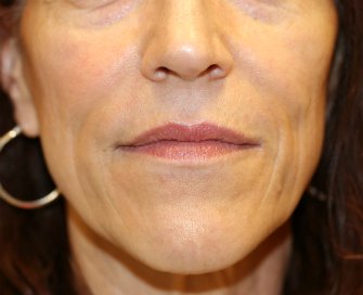 Lip Lines Filler - before - front