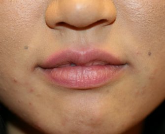 Fuller Lips by Juvederm Ultra Plus - before - front