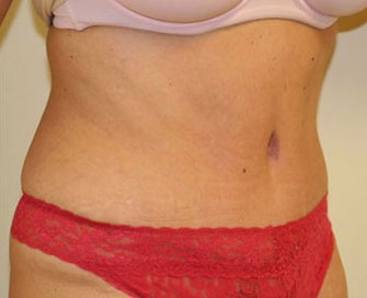 Tummy Tuck Case 1 - after - angle
