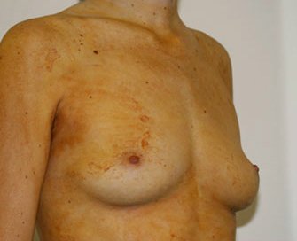 Breast Augmentation Case 7 - before - angle