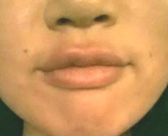 Fuller Lips by Juvederm Ultra Plus - after - front