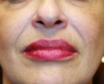 Filler in creases around lips - before - front