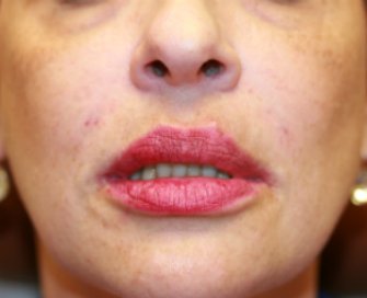 Filler in creases around lips - after - front