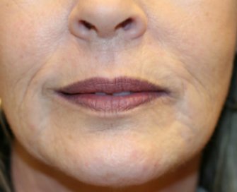 Lip Lines and wrinkles around lips - before - front
