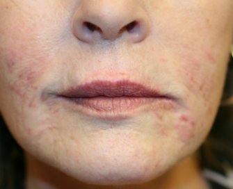 Lip Lines and wrinkles around lips - after - front