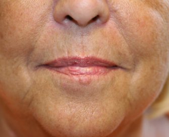 Smile Lines Treatment (filler) - before - front