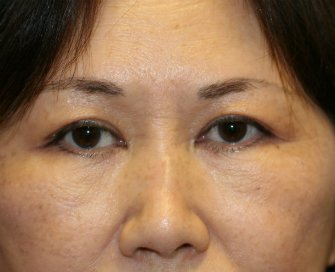 cheek lines-cheek dents - before - front