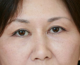 cheek lines-cheek dents - after - front