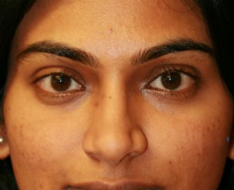 Lower eyelid darkness - before - front