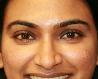 Lower eyelid darkness - after - front
