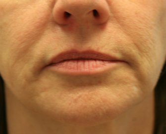 Filler Gel for Smile Lines Around Lips - before - front