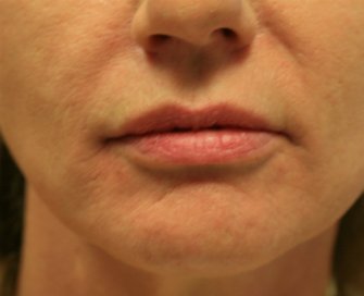 Filler Gel for Smile Lines Around Lips - after - front