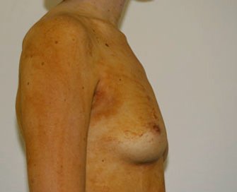 Breast Augmentation Case 7 - before - side