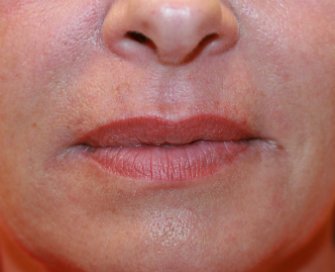 Fine Lines Fine Lip Wrinkles - after - front
