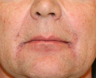 Smile Lines Filling - after - front