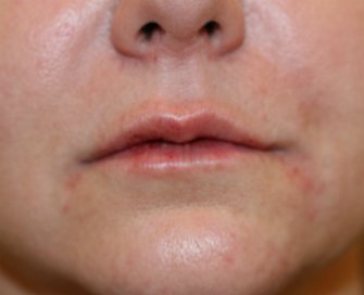 Plump Lips and Turn Up Corners of Lips - after - front