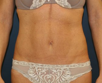 Mini-Tummy-Tuck-San-Diego - after - front