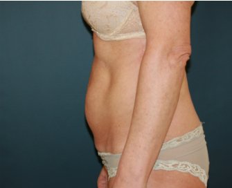 Mini-Tummy-Tuck-San-Diego - before - side