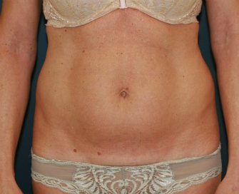 Mini-Tummy-Tuck-Scar-San-Diego - before - front