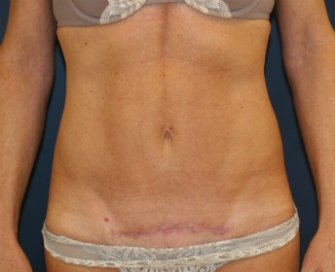 Mini-Tummy-Tuck-Scar-San-Diego - after - front