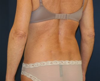 Liposuction Waist, Mini-Tummy Tuck - after - oblique