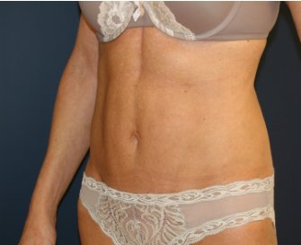 Tummy Tuck San Diego 88 - after - oblique
