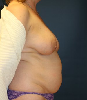 Breast Lift Tummy Tuck - before - side