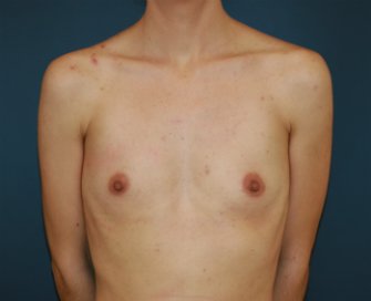 Breast Augmentation Natural 4 - before - front