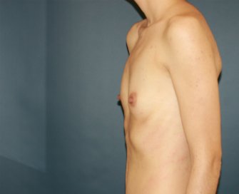 Breast Augmentation Enhancement 121 - before - front