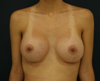 Breast Augmentation Enhancement 121 - after - side