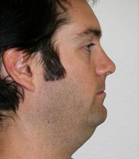 Necklift Case 1 - before - front