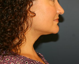 Necklift by liposuction - after - front