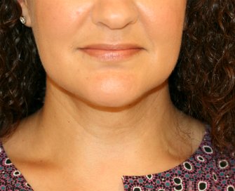 Necklift by liposuction - after - side