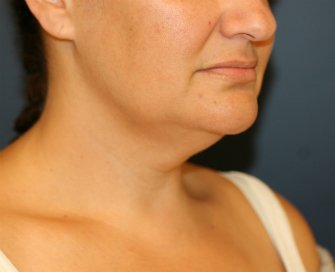 Neck-Lift by Liposuction - before - front