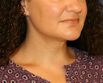 Neck-Lift by Liposuction - after - front