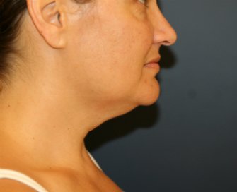 Neck-Lift by Liposuction - before - oblique