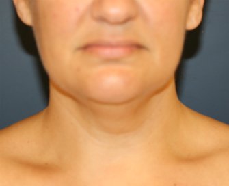 Neck-Lift by Liposuction - before - side